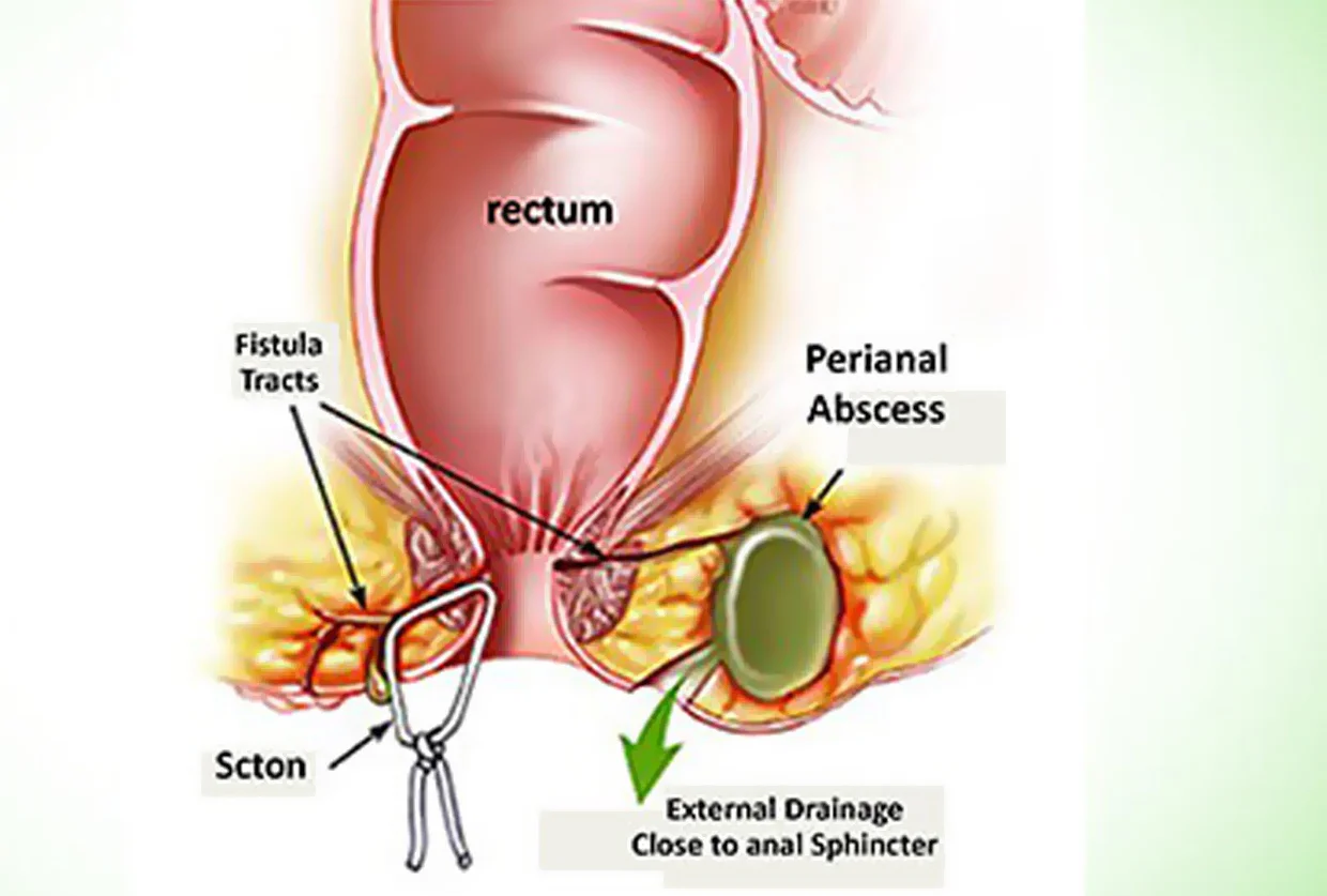Fistula Treatment