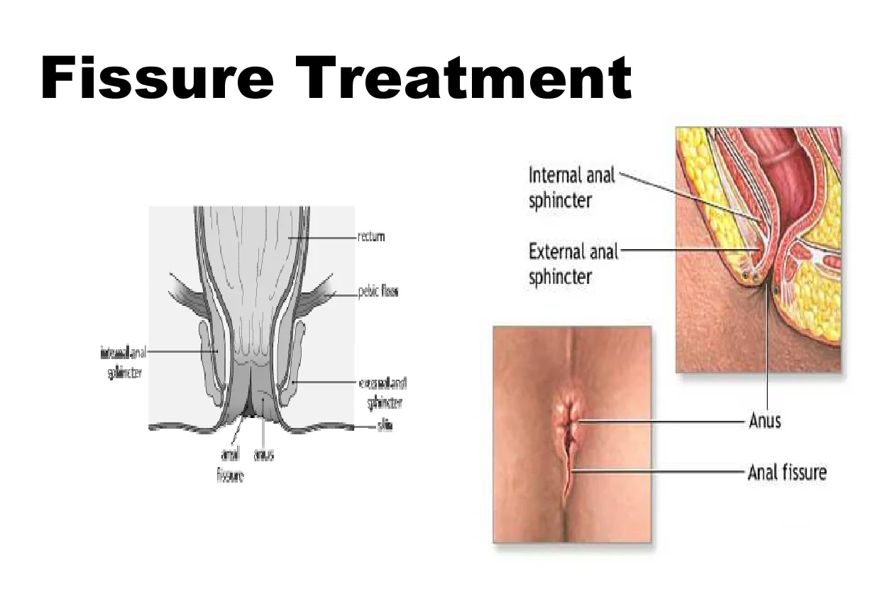 Fissure Treatment