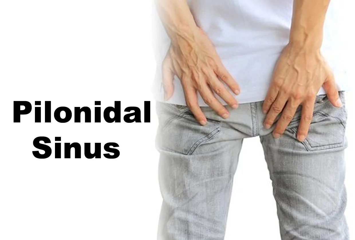 Pilonidal Sinus
